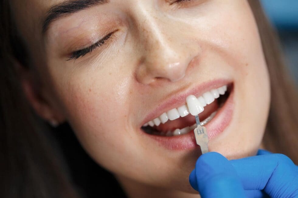 Long-Term Care for Veneers: Tips and Best Practices
