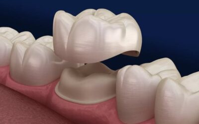 Dental Crowns: Protect & Restore Your Smile 