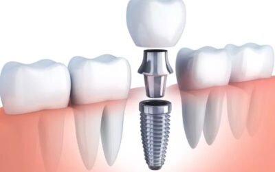 Dental Implants: A Permanent Solution for Missing Teeth  