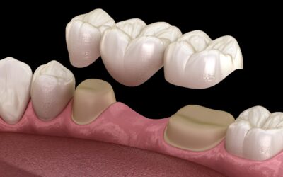 Dental Bridges: Restore Your Smile with Confidence